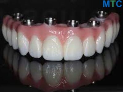 Bruxism Treated with Prettau Zirconia Bridges images