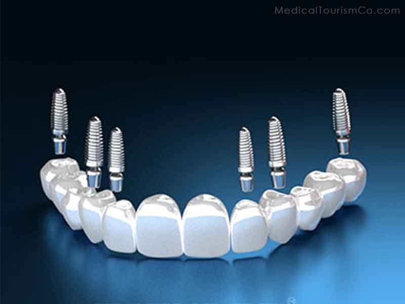 3 on 6 dental implants