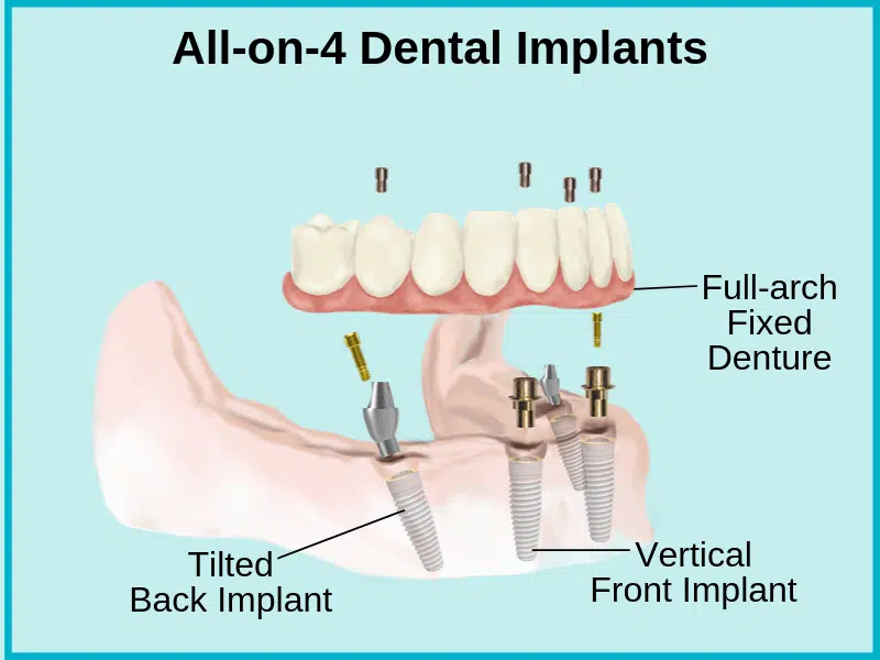 All on 4 dental implants