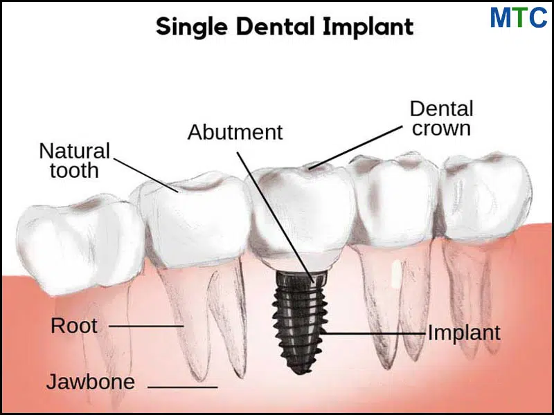 Dental Implants