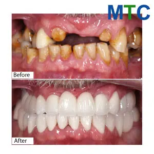 Before & After Dental Veneers in Vietnam