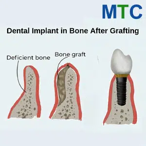 Bone Graft