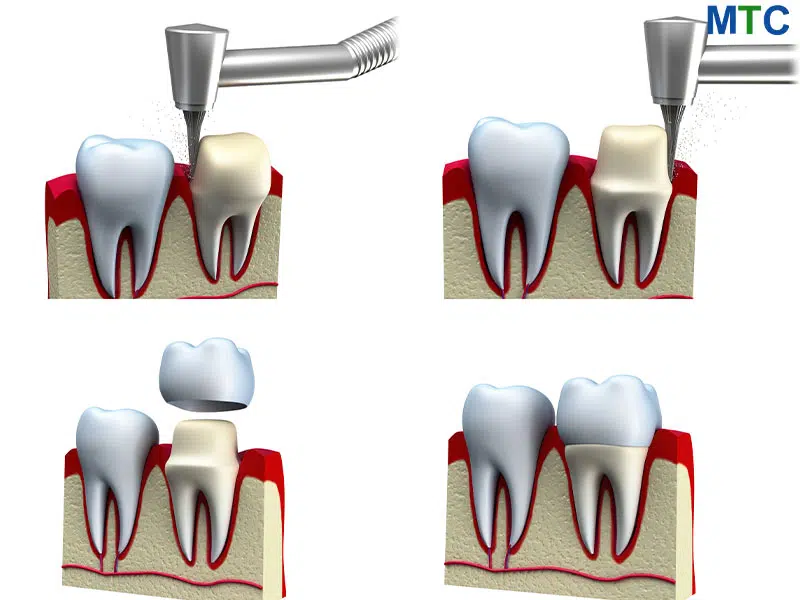 Dental Crowns Procedure