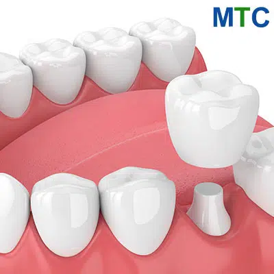 Dental Crowns