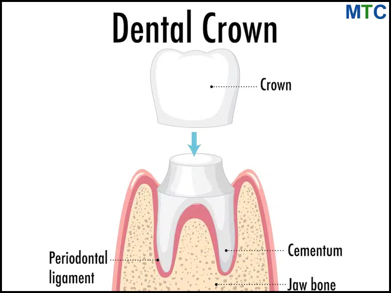 Dental Crown