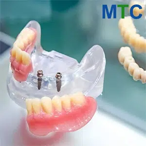 Dental-Implants