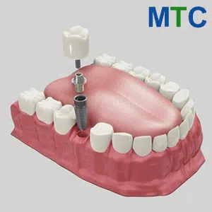 Single Dental Implant