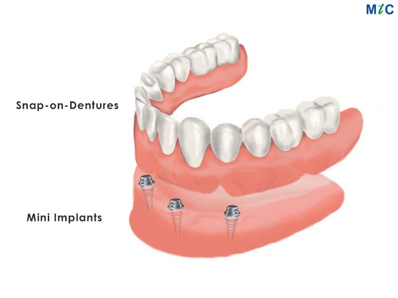 Overdenture