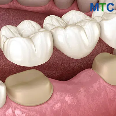 Bridge on healthy teeth