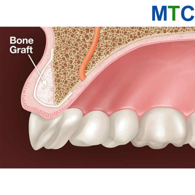 Dental Bone Grafting