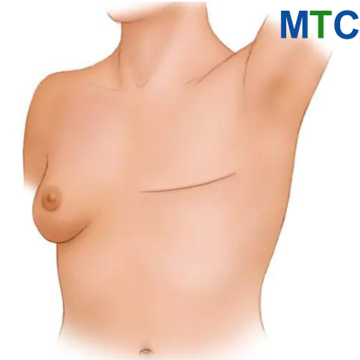 mastectomy