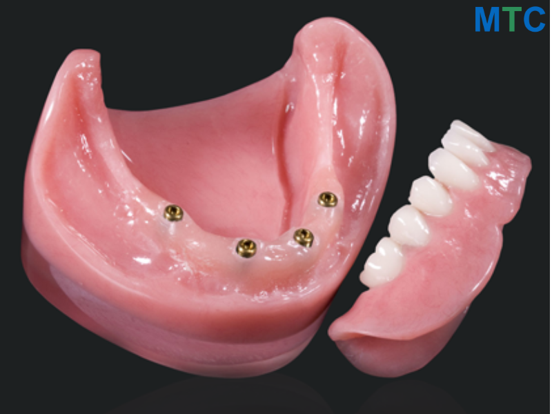 Implant Supported Denture