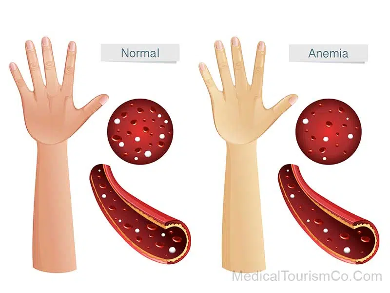 Symptoms of anemia