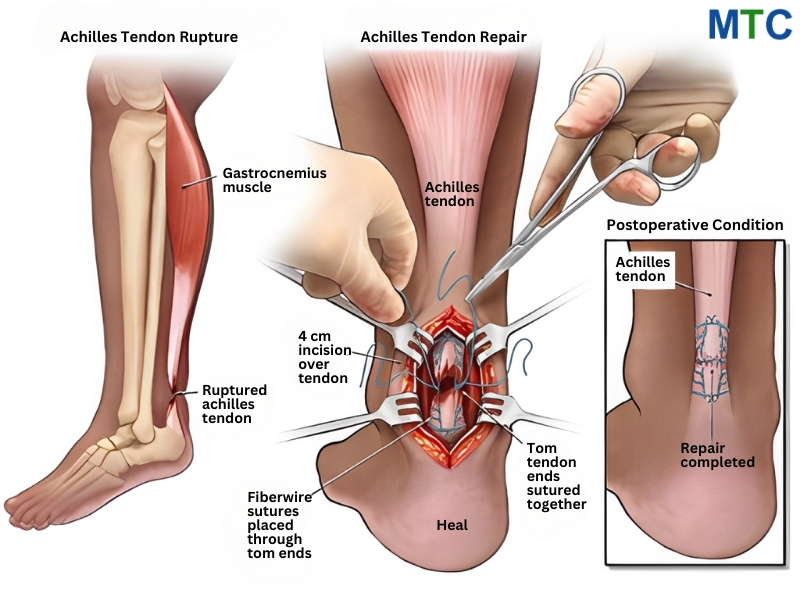 Achilles Tendon Rupture