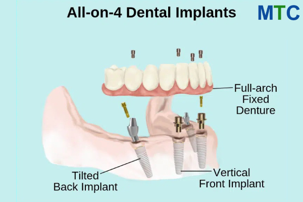 All-on-4 Dental Implants