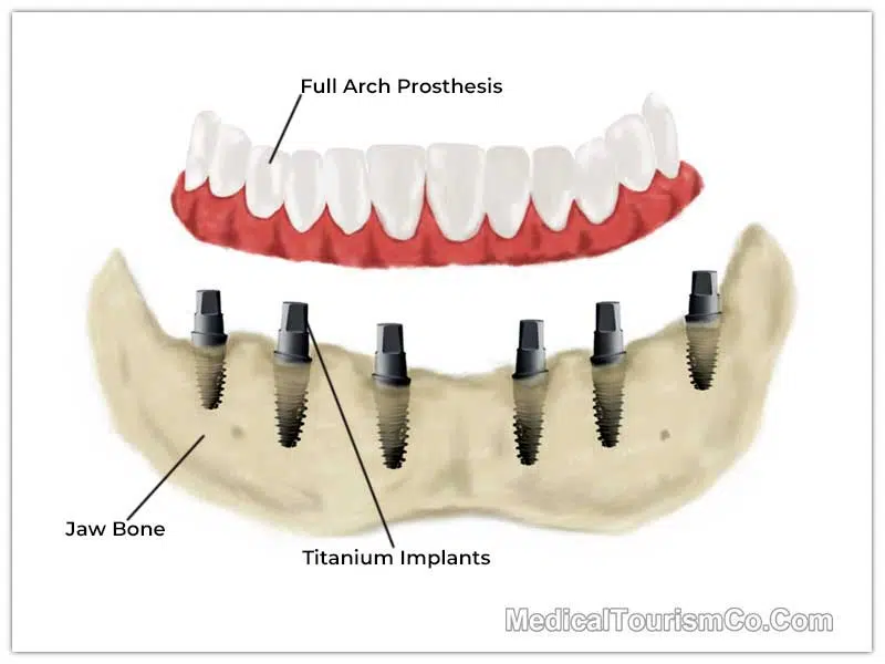 All on 6 Dental Implant