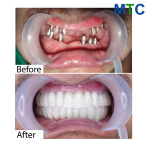 Dental work in Vietnam - Before & after 