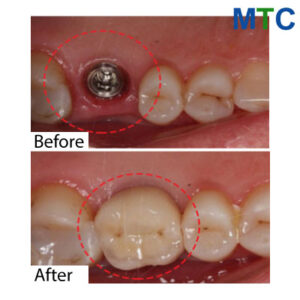 Dental work in Vietnam - Before & after 