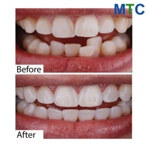 Dental work in Vietnam - Before & after 