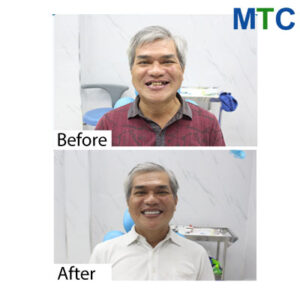 Dental work in Vietnam - Before & after 