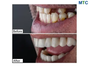 Before After Dental Implants in Izmir Turkey