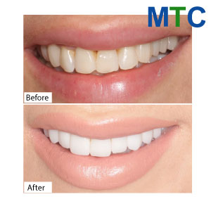 Before After Dental Veneers Crowns in Bucharest