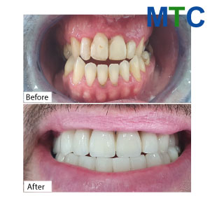 Before-After-Emax-Zirconia-Crowns-in-Bucharest