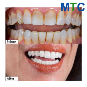 Before-After-dental-veneers-in-Vietnam