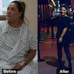 Before after gastric sleeve in mexico