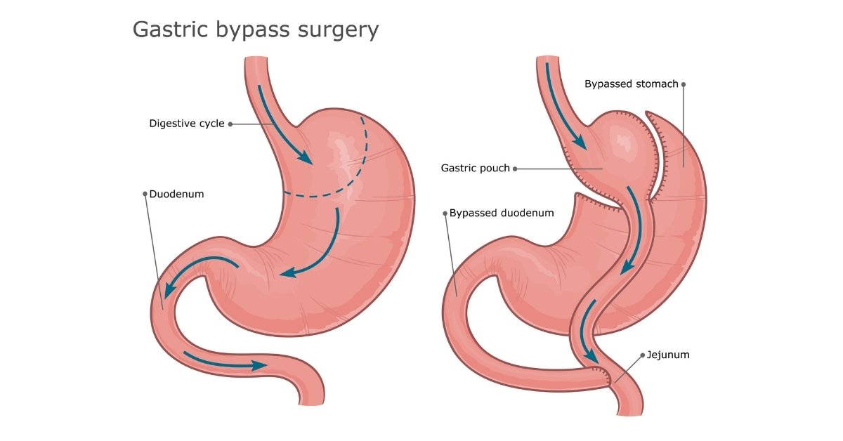 Gastric Bypass in Las Vegas