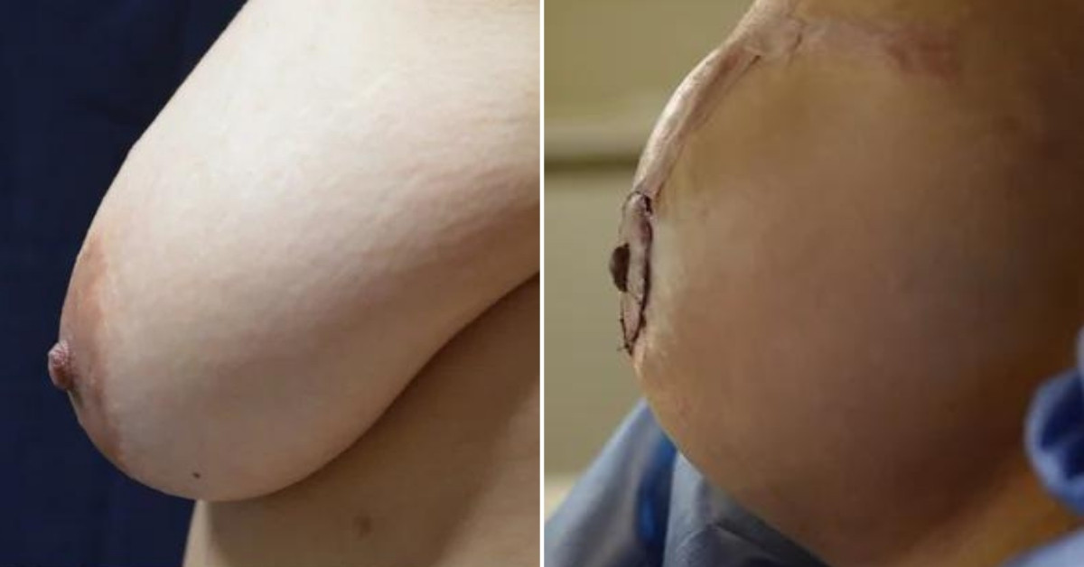 Breast Lift in Tijuana, Mexico