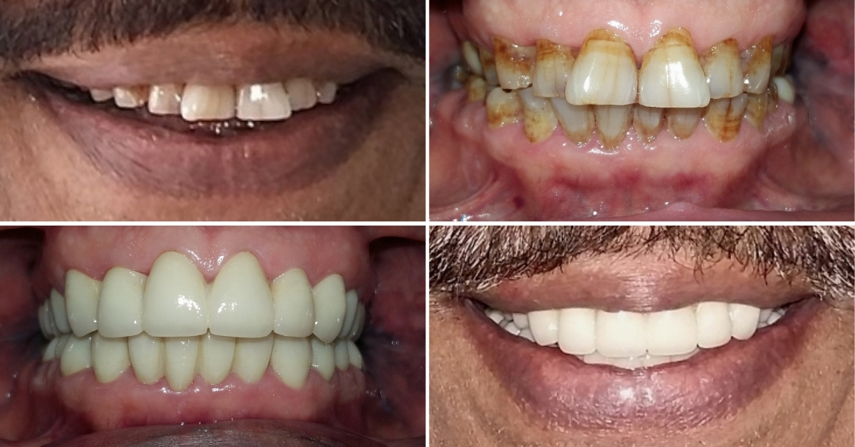 Client Reviews Full Mouth Restoration in Cancun – Mexico