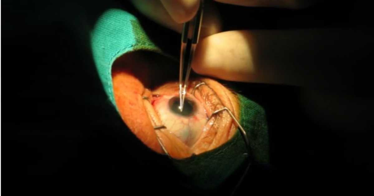 Corneal Transplantation Istanbul – Turkey