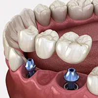 Dental Bridge