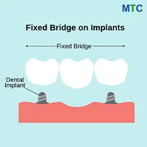 Dental Bridge