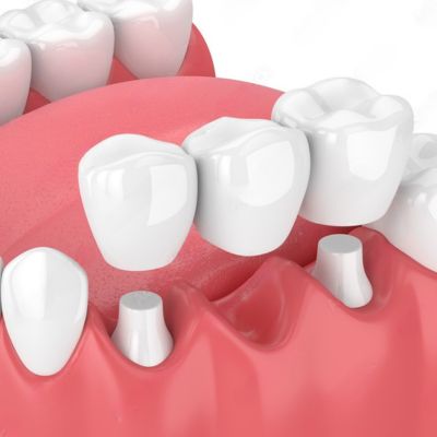 dental bridges