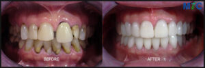 Dental Crowns Before and After