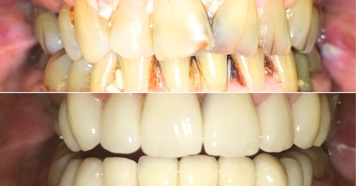 Sharon MacDonald’s Testimonial – Dental Crowns in Phuket