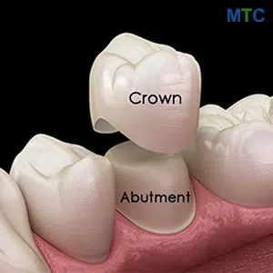 Dental Crowns