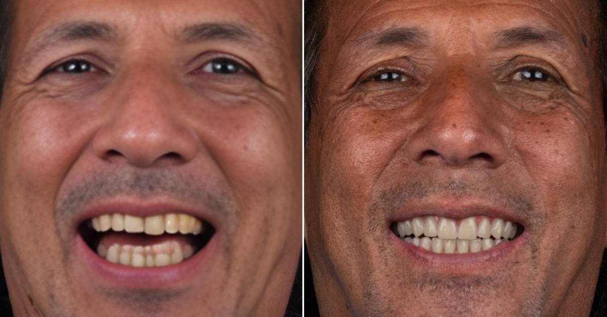 Dental Implants in Brazil: For a Lasting Smile