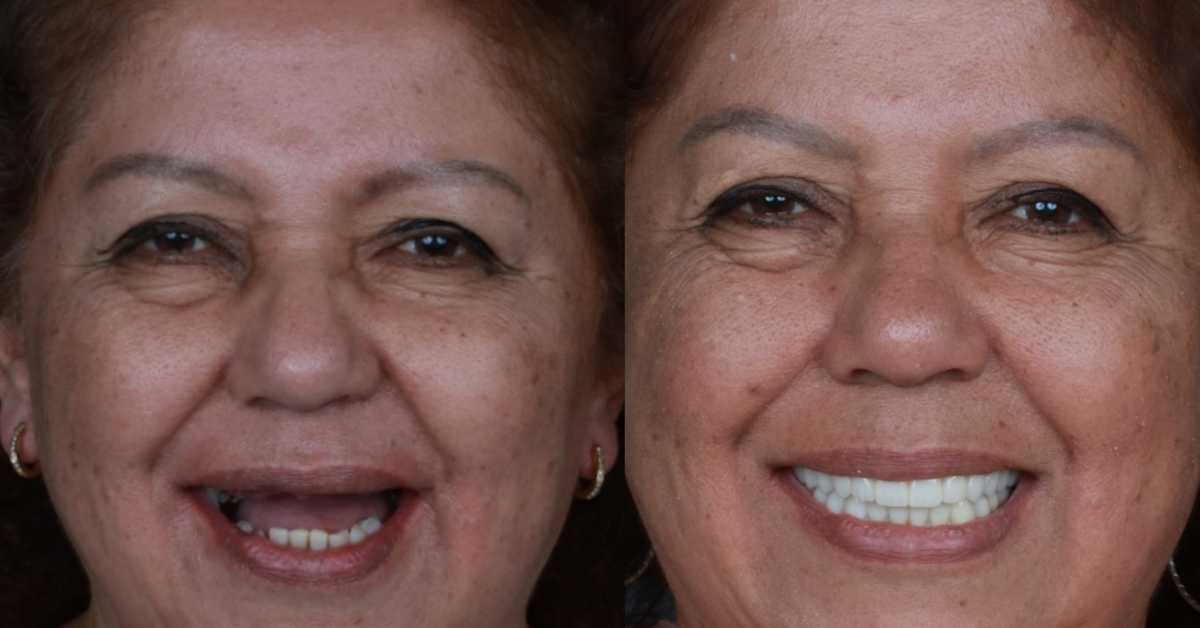 Dental Implants in Guatemala City, Guatemala