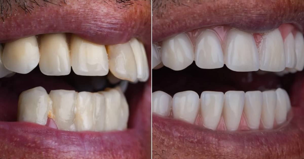 Dental Implants in Rio de Janeiro, Brazil