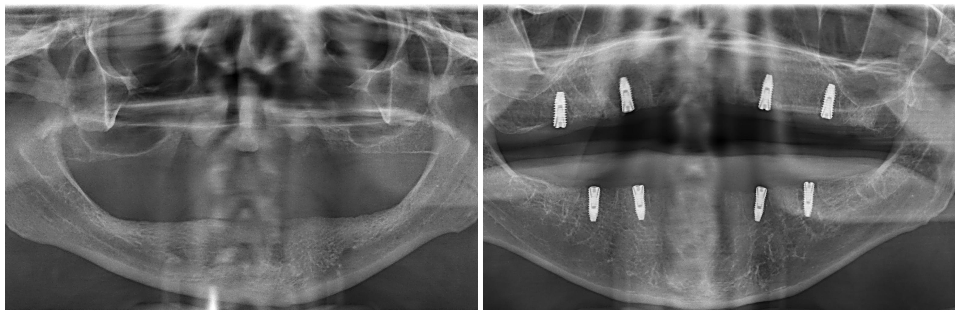 Dental Implants in US-Mexico Border Areas