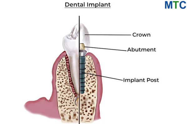 Dental Implants