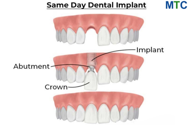 Same Day Dental Implant