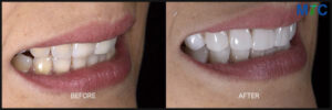 Smile Makeover Before and After