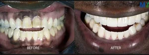 Smile Makeover Before and After