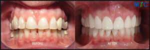 Dental Crowns Before and After