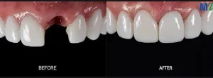 Dental Implants Before and After