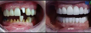 Dental Implants Before and After